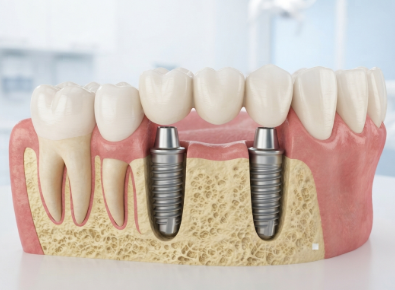 Multiple Teeth Implant Bridge